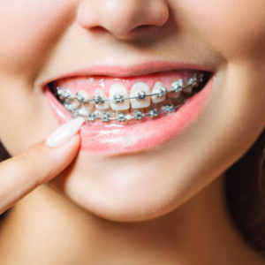 Ortodonti: Bilmeniz gerekenler!