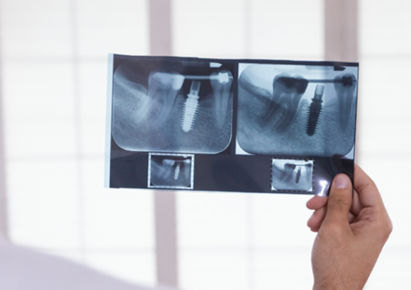 Oral and Maxillofacial Surgery (Impacted Teeth and Cyst operations)