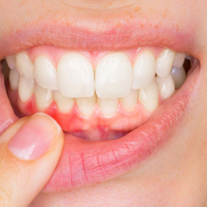 Diş eti Hastalıkları – Periodontoloji