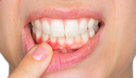 Diş eti Hastalıkları – Periodontoloji