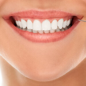 Dental Veneers: The Ultimate Guide to Perfect Teeth